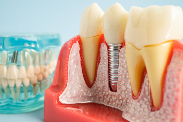 Best Dental Inlays and Onlays  in USA